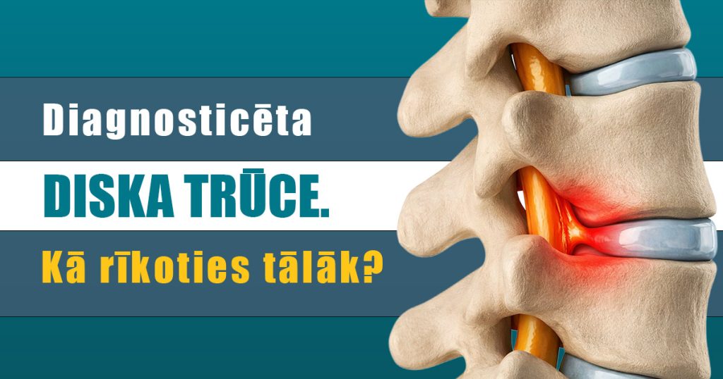 Diagnosticēta diska trūce. Kā rīkoties tālāk