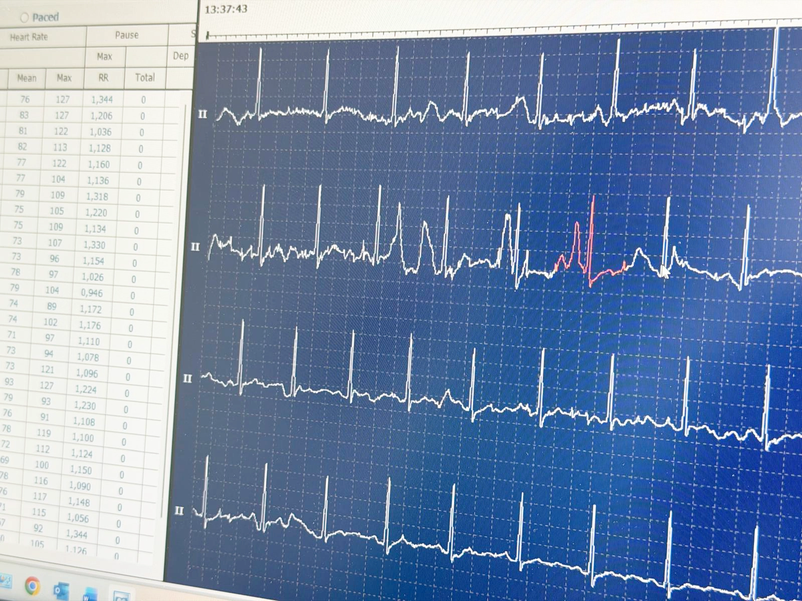 EKG Holtera monitorēšana (24–168 h) neiromed ASTRA
