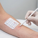 Alerģiskā dermatīta diagnostika un ārstēšana