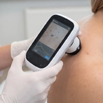 Dermatoskopija (dzimumzīmju un citu ādas veidojumu pārbaude)