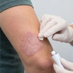 Psoriāzes un ekzēmas diagnostika un ārstēšana